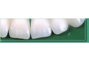 Dentex Sp. z o.o.: producent zębów akrylowych, protezy, artykuły protetyczne, ścierniki, zęby przednie dolne, zęby przednie górne Zduńska Wola